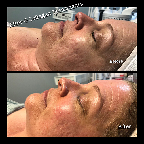 Before and After Procell Treatment