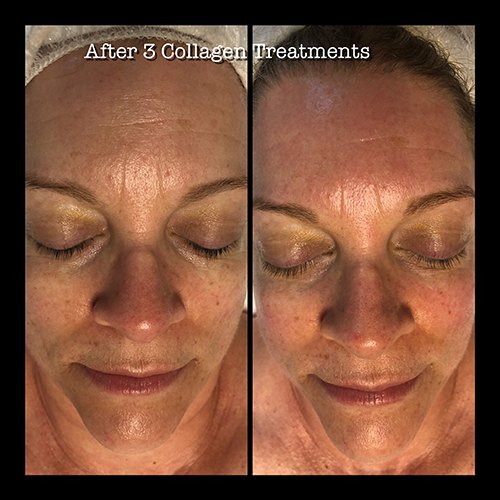 Before and After Treatment 2
